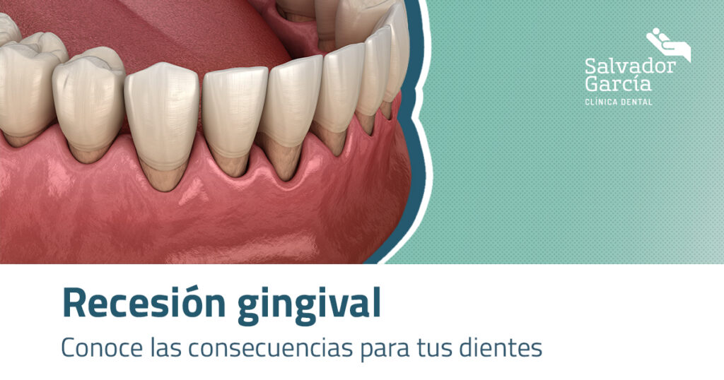 clasificación de la recesión gingival