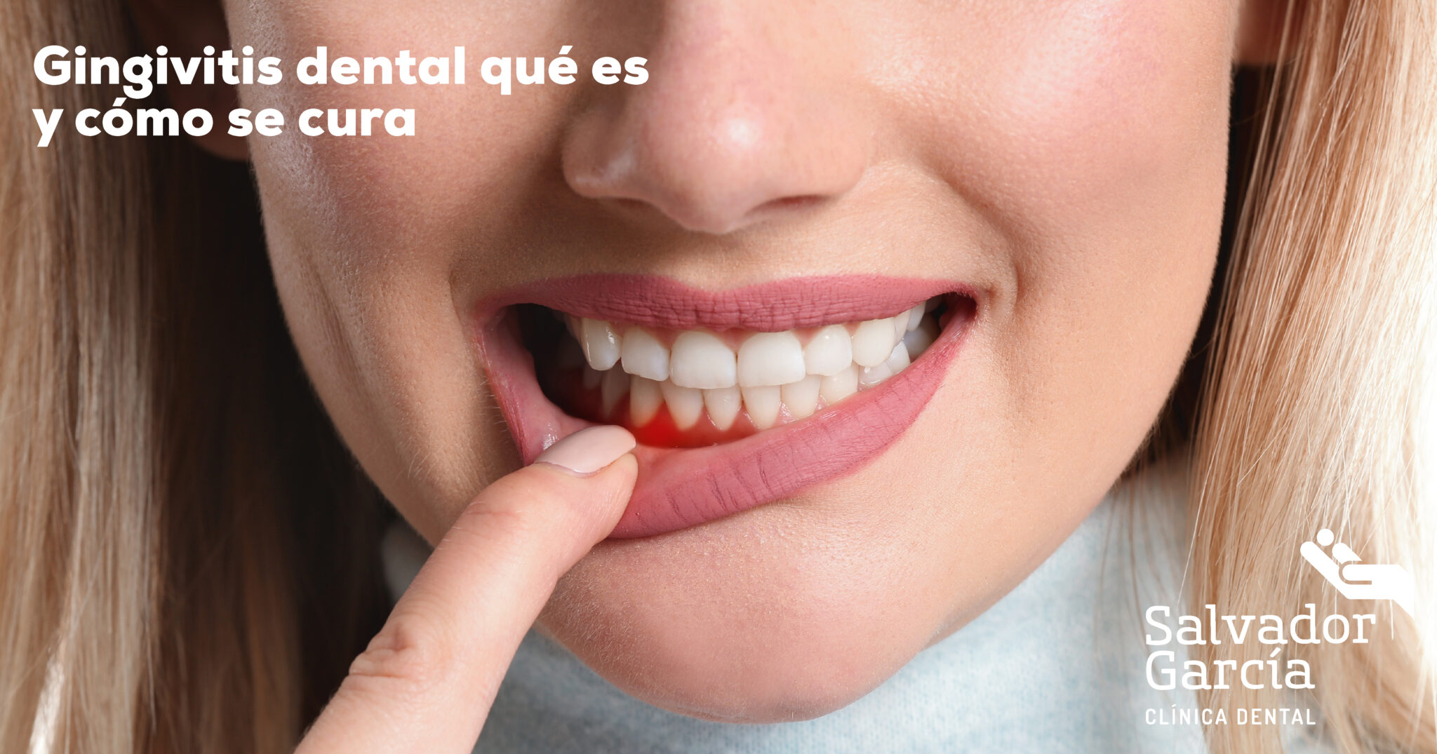 ¿Qué Es La Gingivitis Dental Y Cómo Se Cura? Síntomas Y Tratamientos