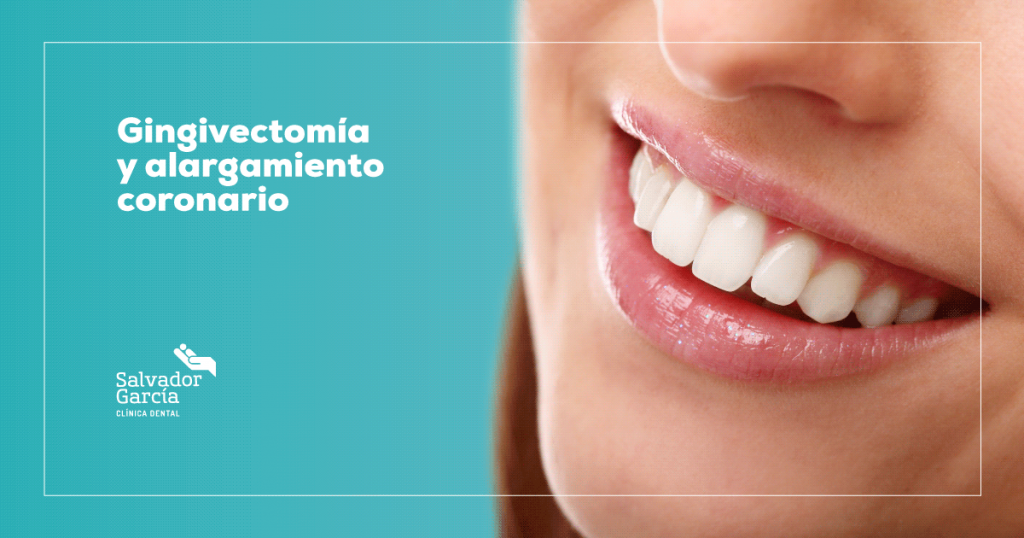 Gingivectomía alargamiento coronario